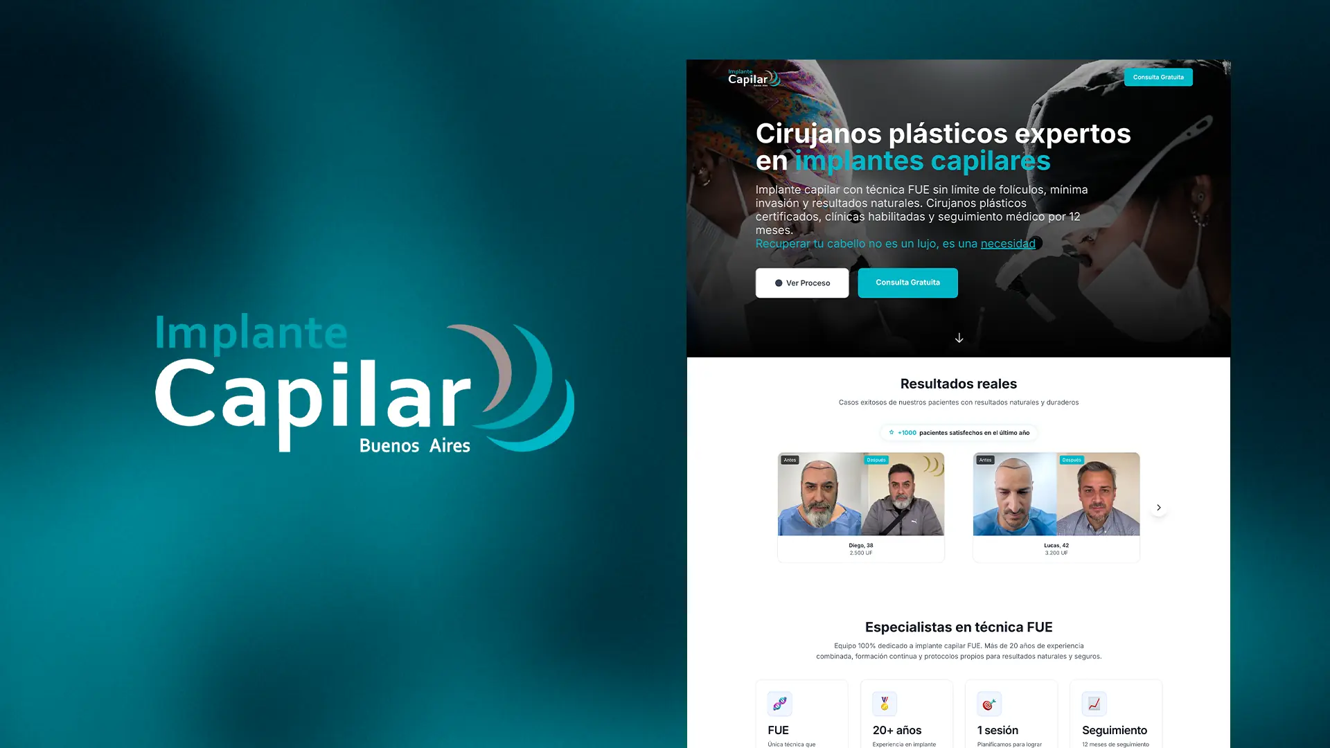 Implante Capilar Buenos Aires